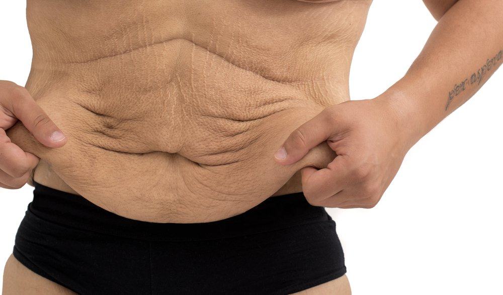 Abdominoplastia