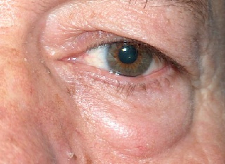 Blefaroplastia