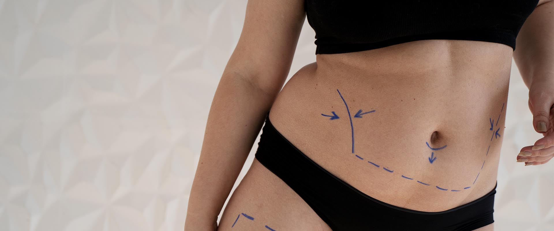 Conventional Liposculpture