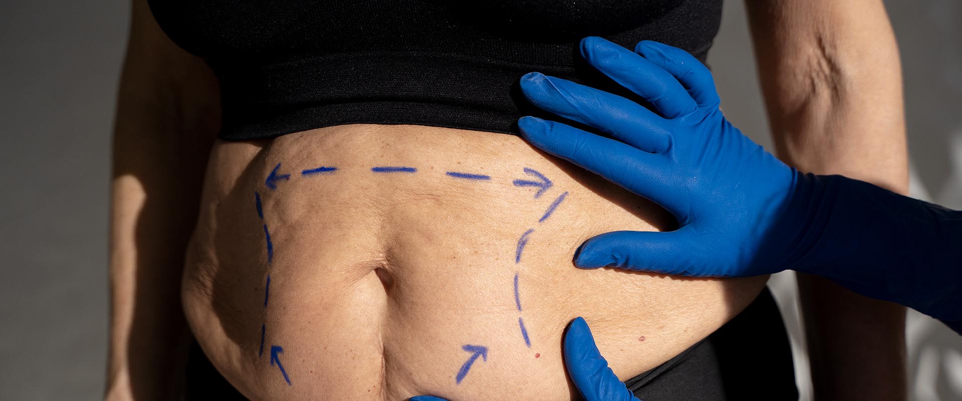 Abdominoplastia post bariátrica