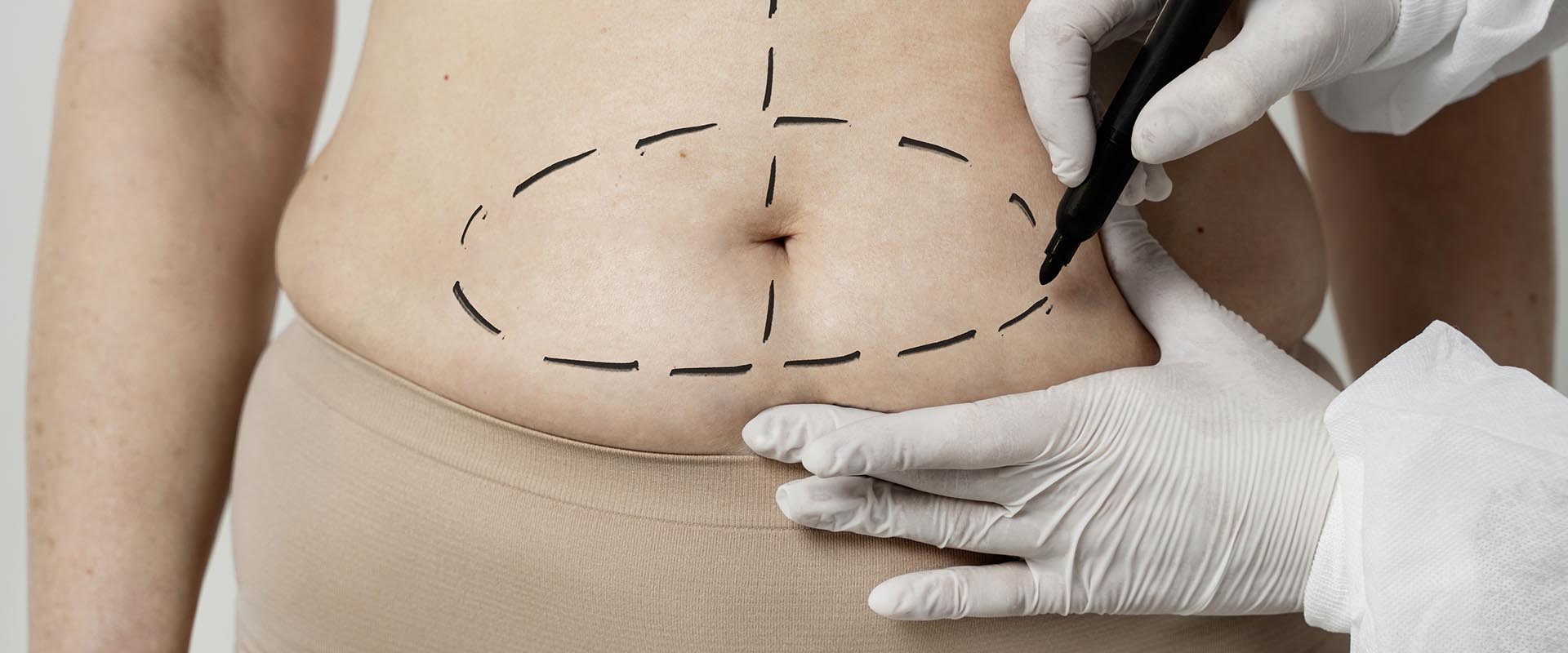 Abdominoplastia