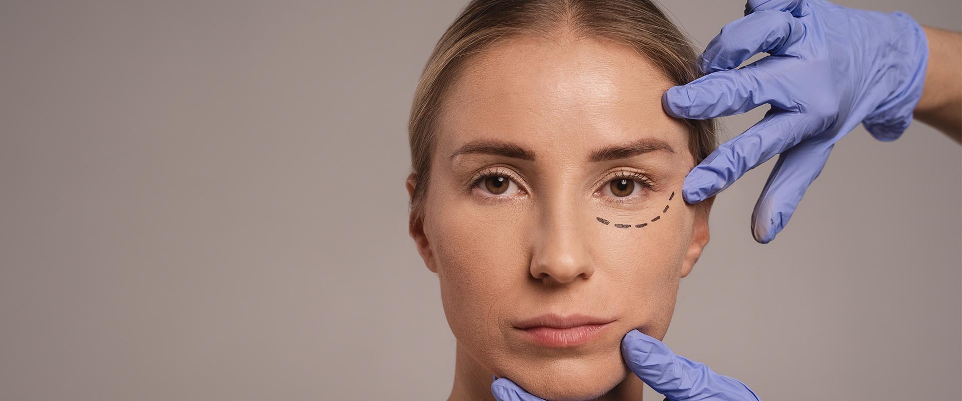 Transconjunctival blepharoplasty