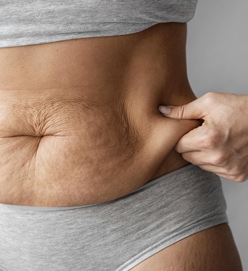 abdominoplastia posbariatrica