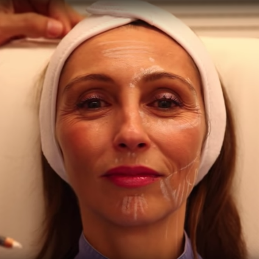 paciente femenina con arrugas