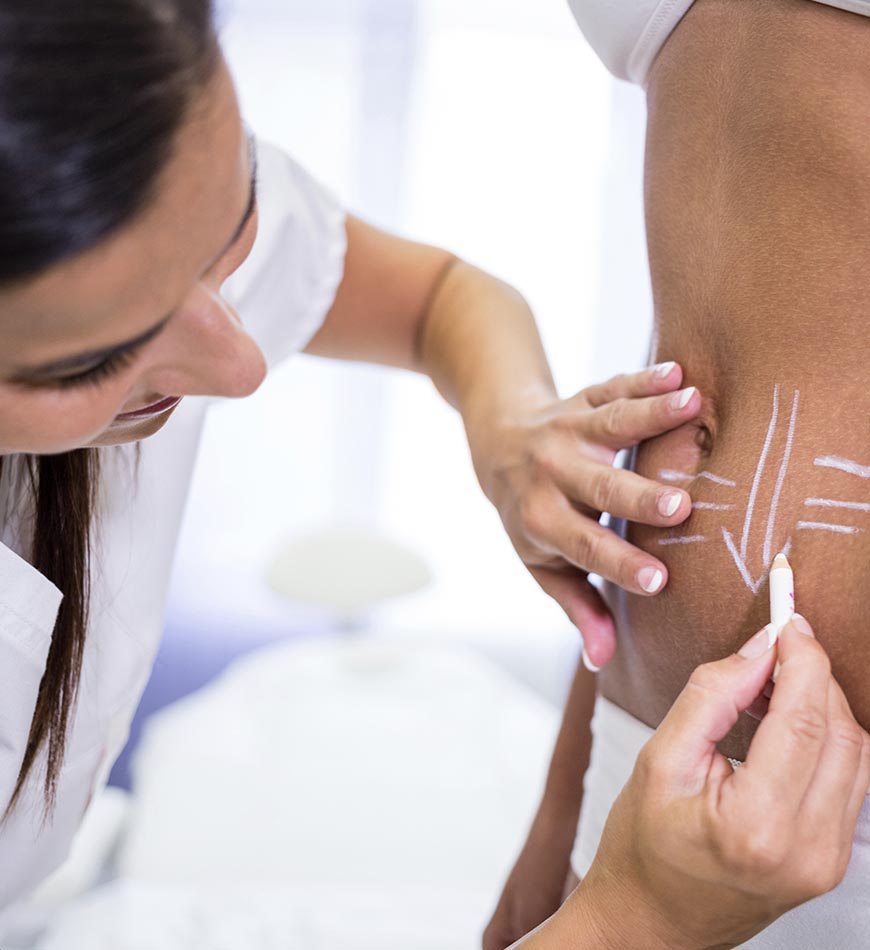 lipoescultura con marcacion