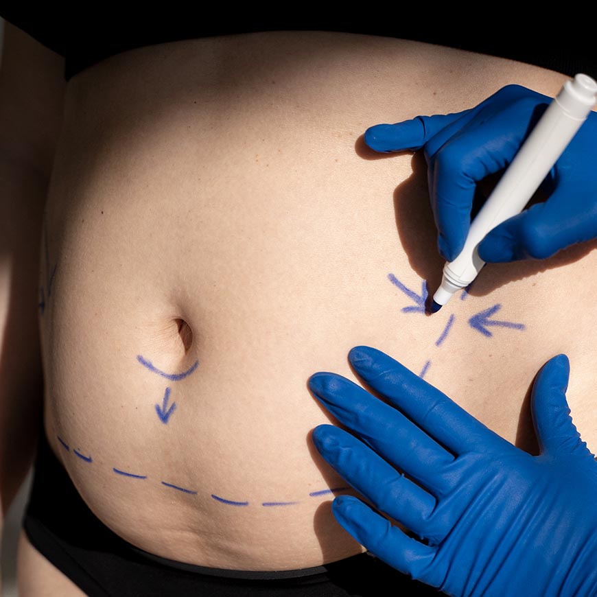 marcacion cirugia plastica