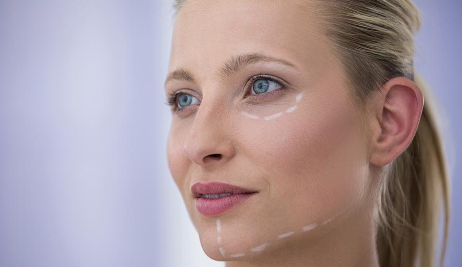 Hilos de sustentación facial