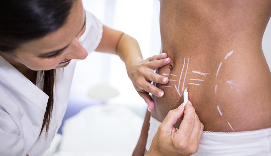lipoabdominoplastia