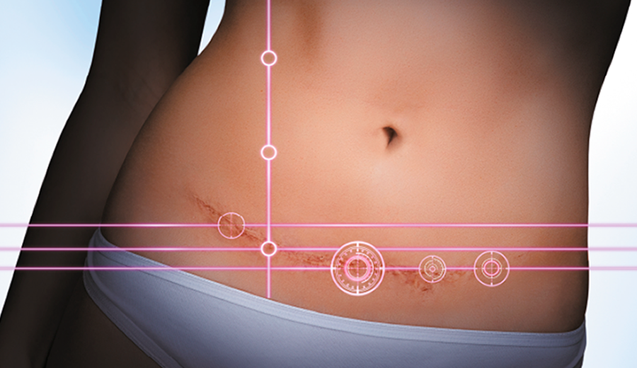 cicatriz abdominoplastia