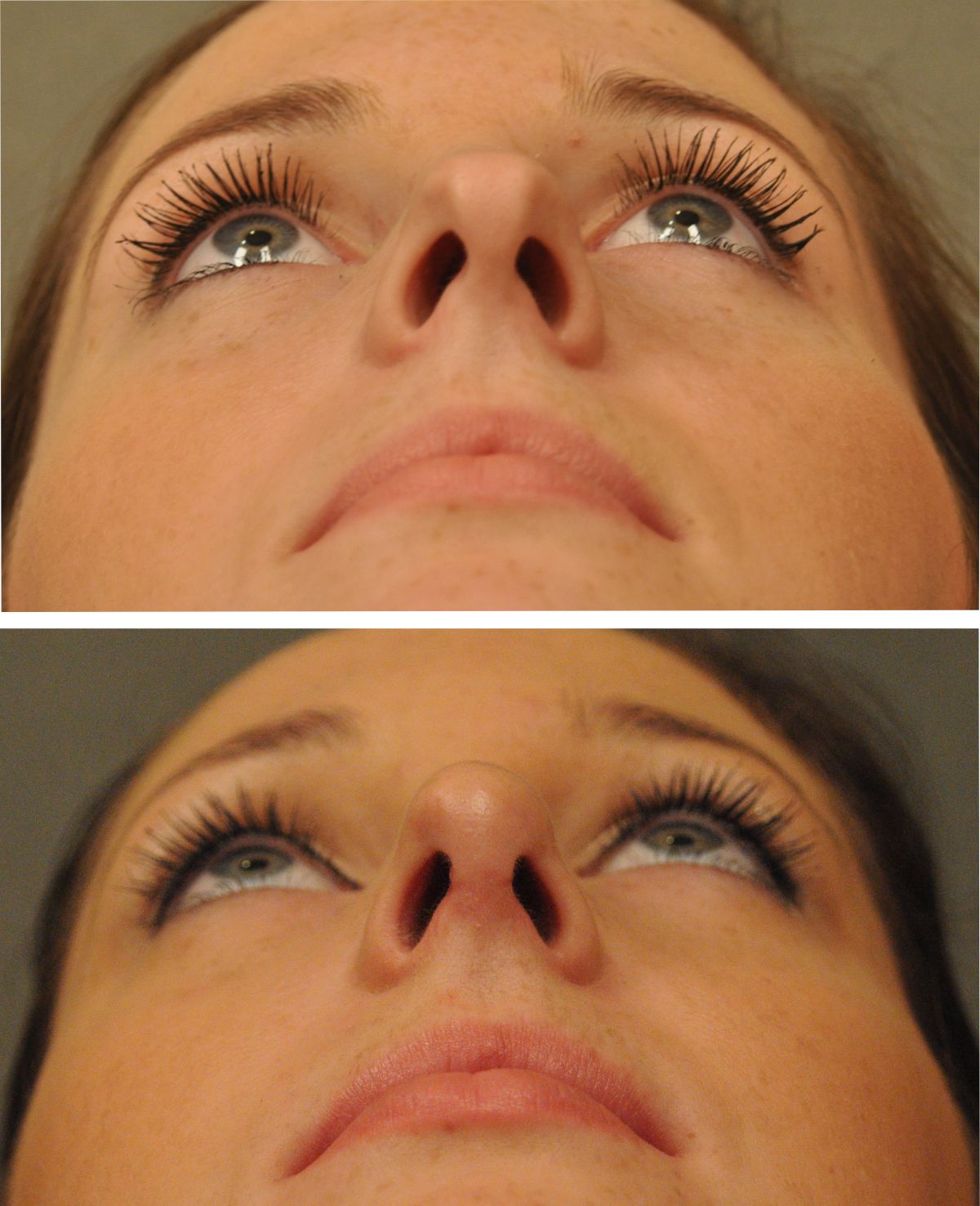 rinoplastia abierta