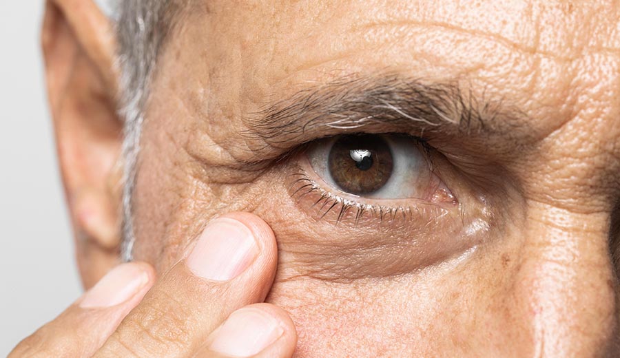 blefaroplastia masculina