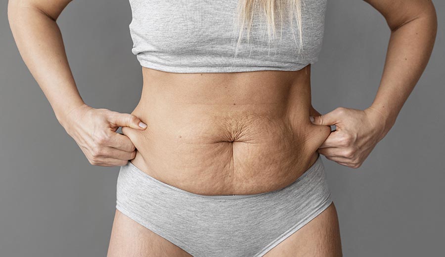 abdominoplastia